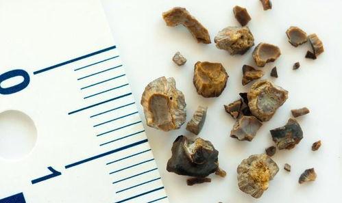 肾结石能吃黑瓜吗女性怎么吃,肾结石患者女性食用黑瓜的适宜方法与注意事项